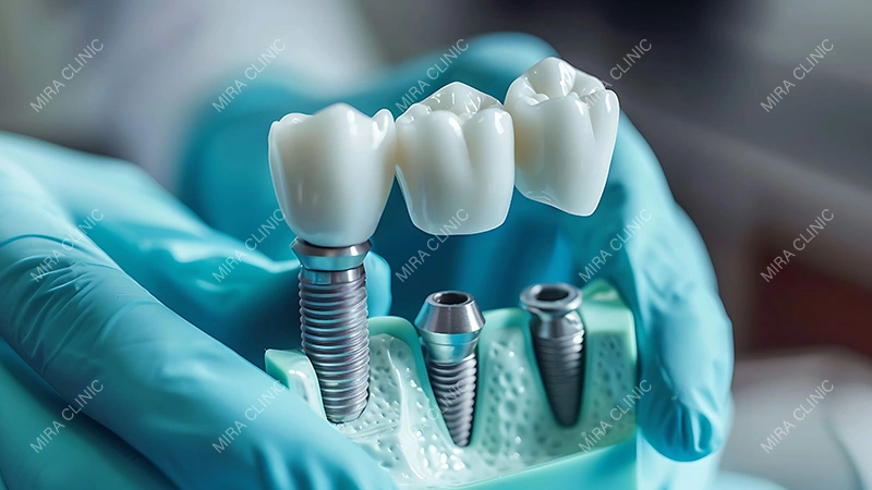 Implant brand